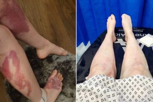 Severe Pain Caused by Unexpected Household Item Explosion
